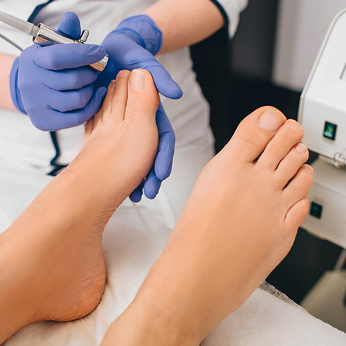 Fungal Toenail Laser Treatment